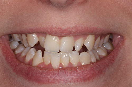 Before image shows stained composite fillings before treatment at Bupa Dental Care Congleton